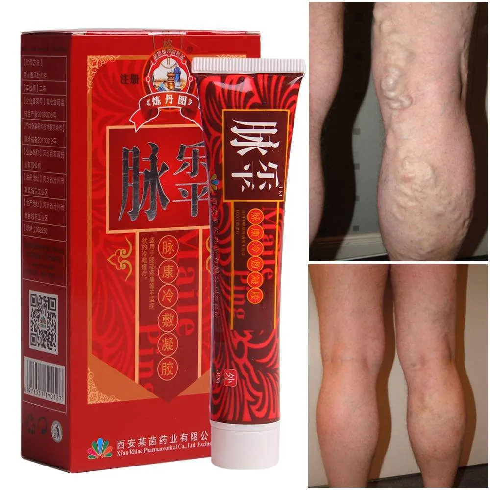 Varicose Veins Treatment Cream Ointment Vasculitis Angitis Phlebitis Spider Veins Pain Remedy Herbal